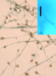 First case of chromoblastomycosis due to Phoma insulana Primer caso de cromoblastomicosis causado por Phoma insulana