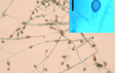First case of chromoblastomycosis due to Phoma insulana Primer caso de cromoblastomicosis causado por Phoma insulana