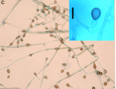 First case of chromoblastomycosis due to Phoma insulana Primer caso de cromoblastomicosis causado por Phoma insulana